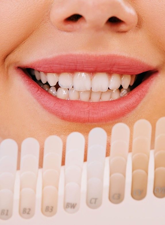 Faccette senza limatura dentale: immagine illustrativa
